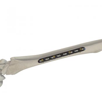 尺、橈骨鎖定接骨板